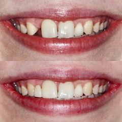 DENTAL-BRIDGE-BEFORE-AFTER