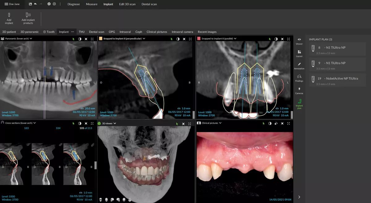 CBCT scan