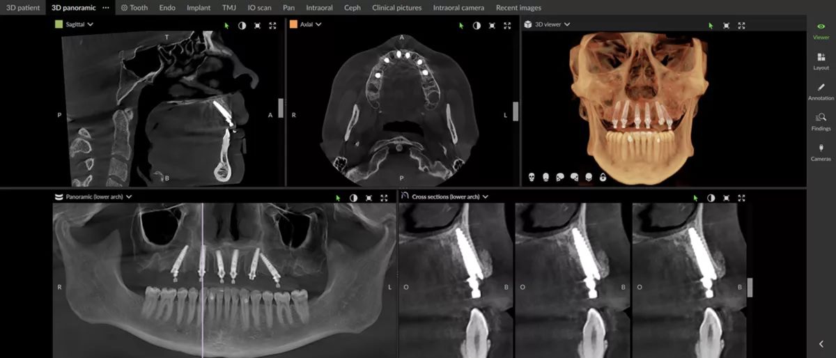 CBCT scan