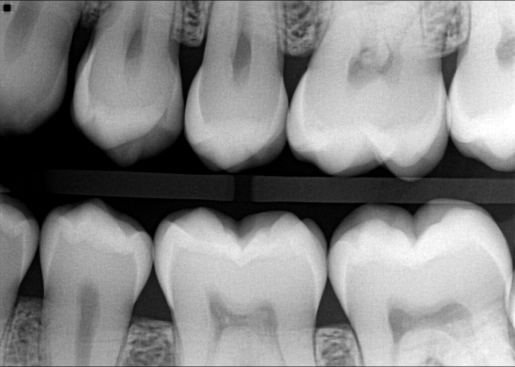 Dental X-rays